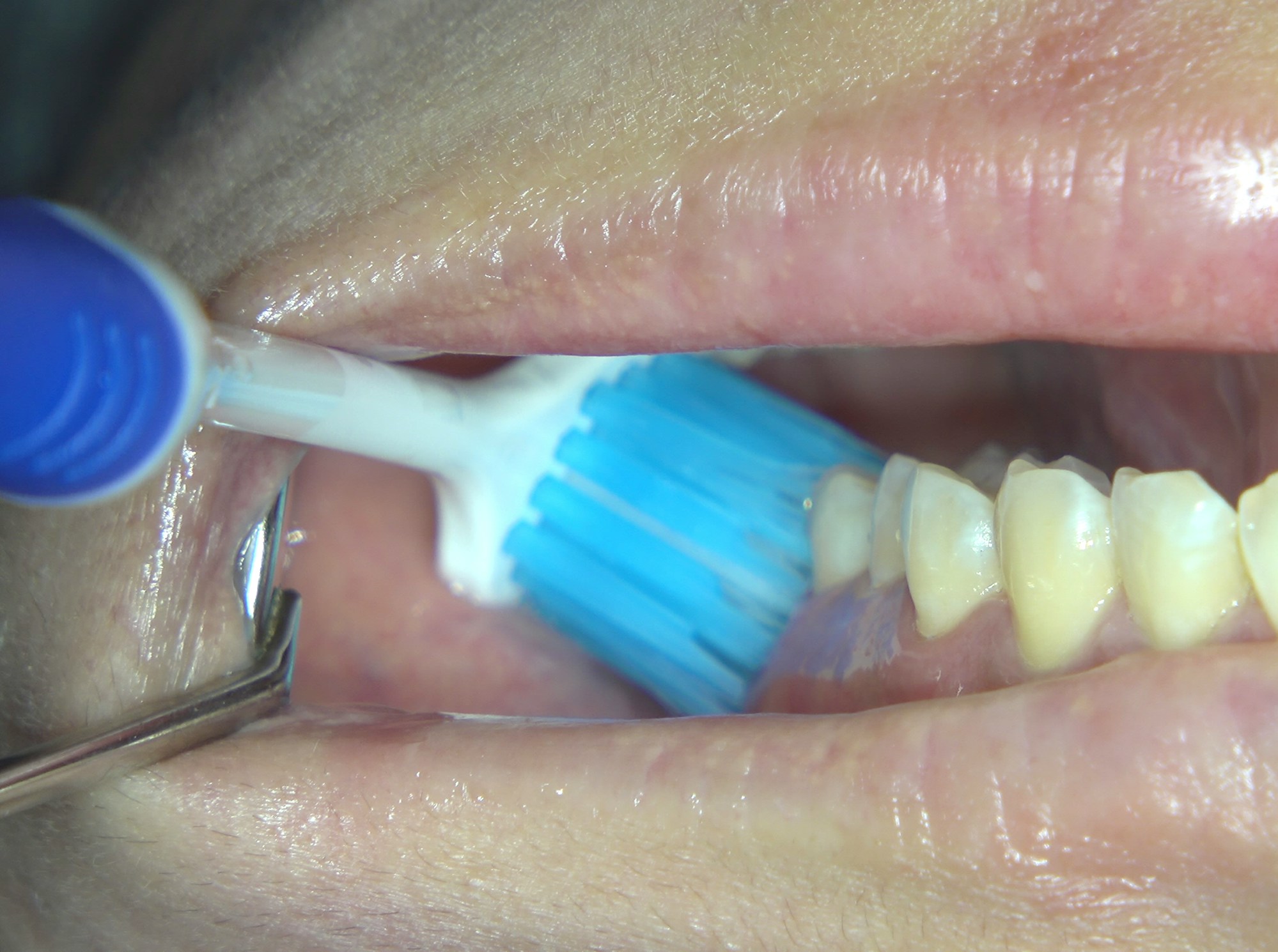 將口腔微微合起來 
上顎臼齒外側面會有更多空間更容易清潔乾淨