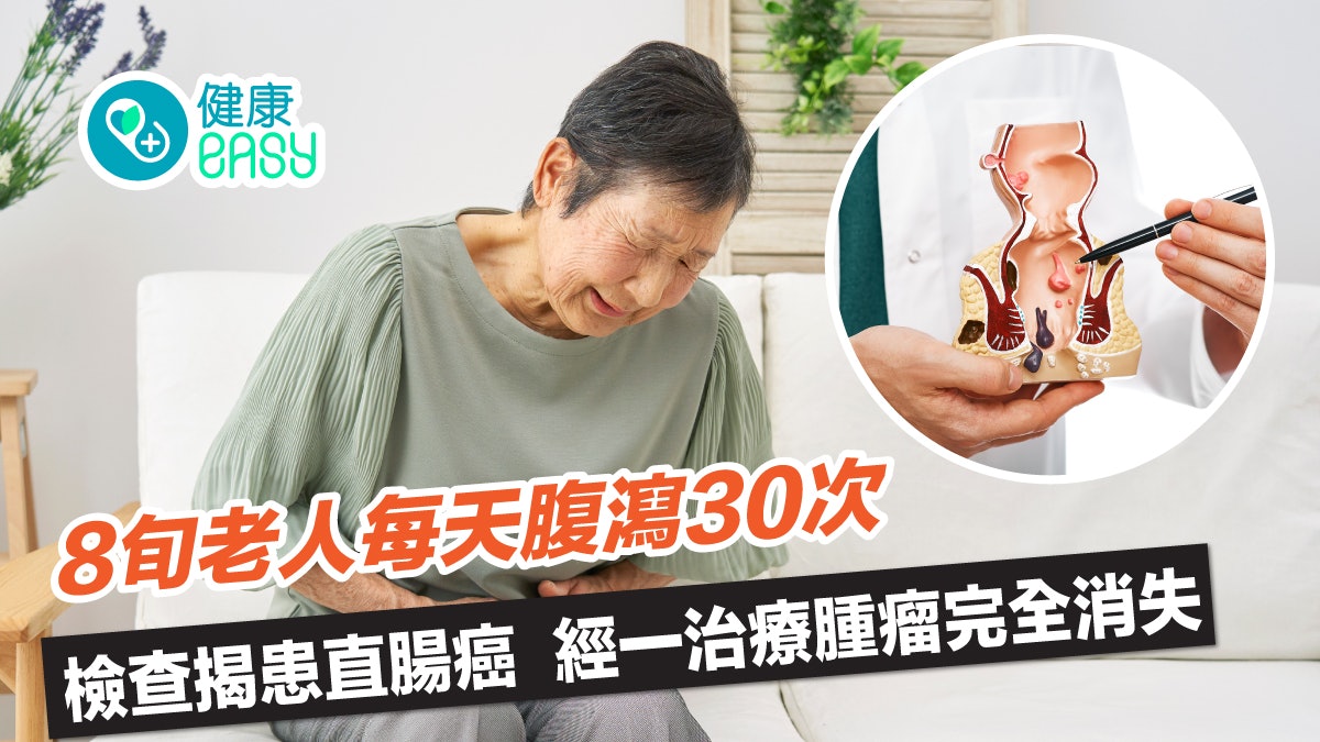 癌症|8旬老人每天腹瀉30次終確診直腸癌!經這治療腫瘤完全消失 癌症|8旬老人每天腹瀉30次終確診直腸癌!經這治療腫瘤完全消失