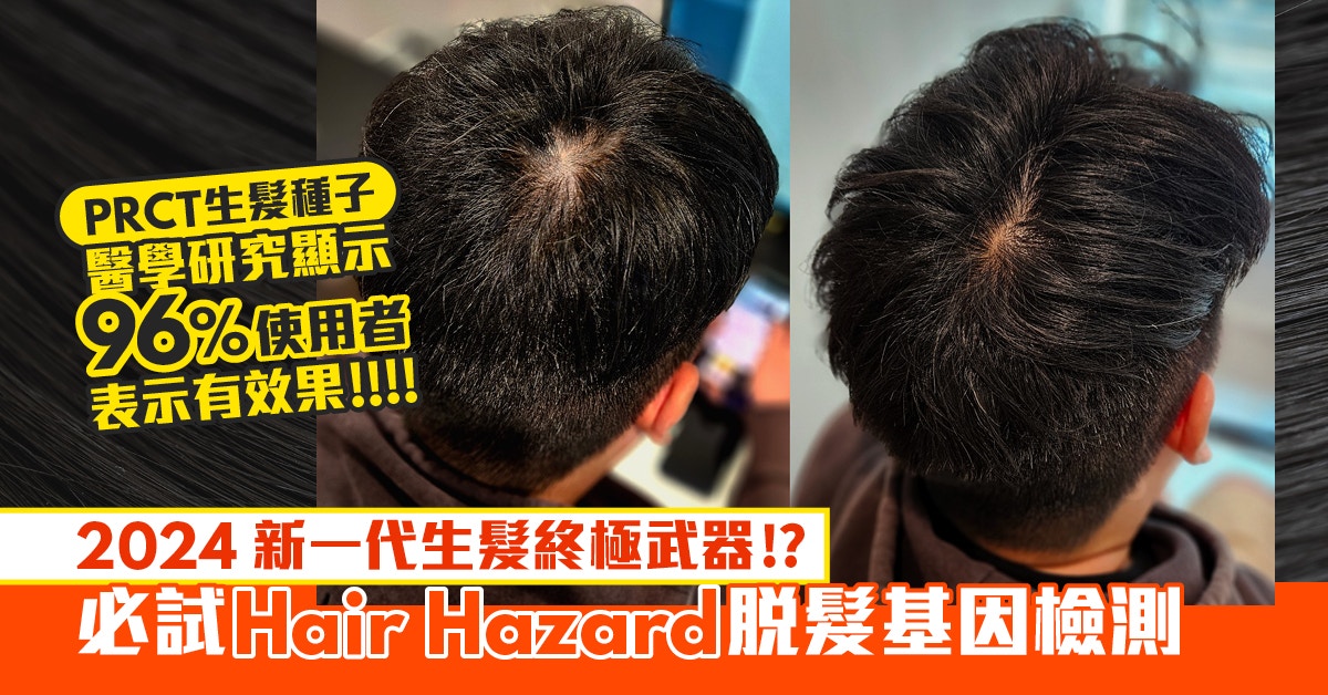 仲有幾耐你就變秃頭?Hair Hazard脫髮基因檢測幫你趁早救髮止脫髮