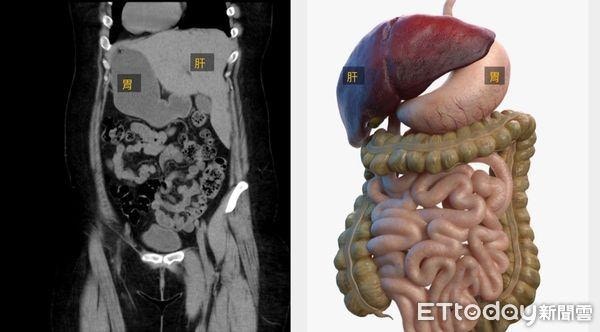 李女的心臟、肺臟、胃腸道等器官位置都與常人的左右相反，圖左為李女的身體掃描，圖右為常人的身體器官分布。（《ETtoday新聞雲》）