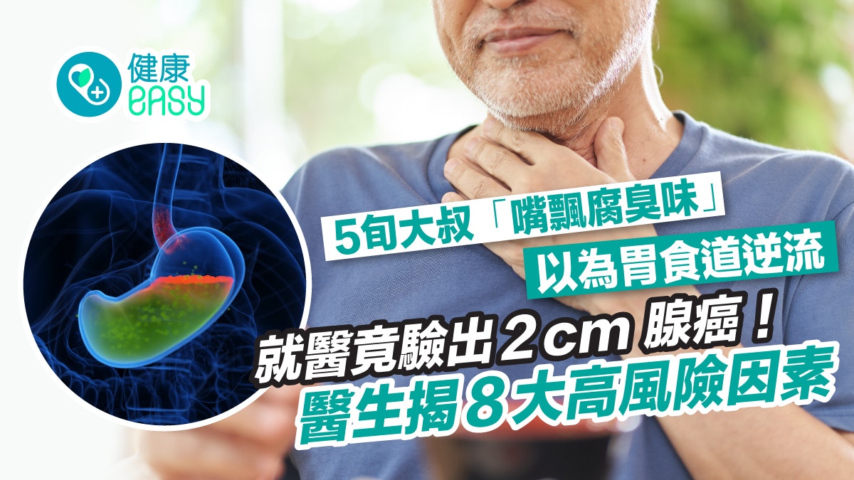 癌症|中年大叔「嘴飄腐臭味」以為胃酸倒流!就醫竟驗出2cm腺癌 癌症|中年大叔「嘴飄腐臭味」以為胃酸倒流!就醫竟驗出2cm腺癌
