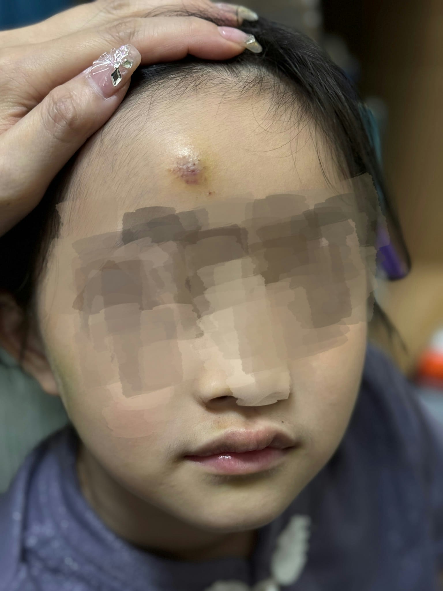 女童家长昨晚（6月4日）上载女儿伤势照片，女童身体多处瘀伤，牙齿受损、额头有瘀青。（网民Lin Ng图片）