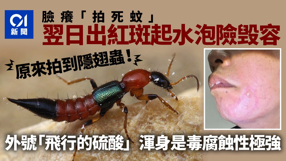 隱翅蟲全身毒汁腐蝕性有多強?女子以為是蚊隨手拍死「差點毀容」 隱翅蟲全身毒汁腐蝕性有多強?女子以為是蚊隨手拍死「差點毀容」