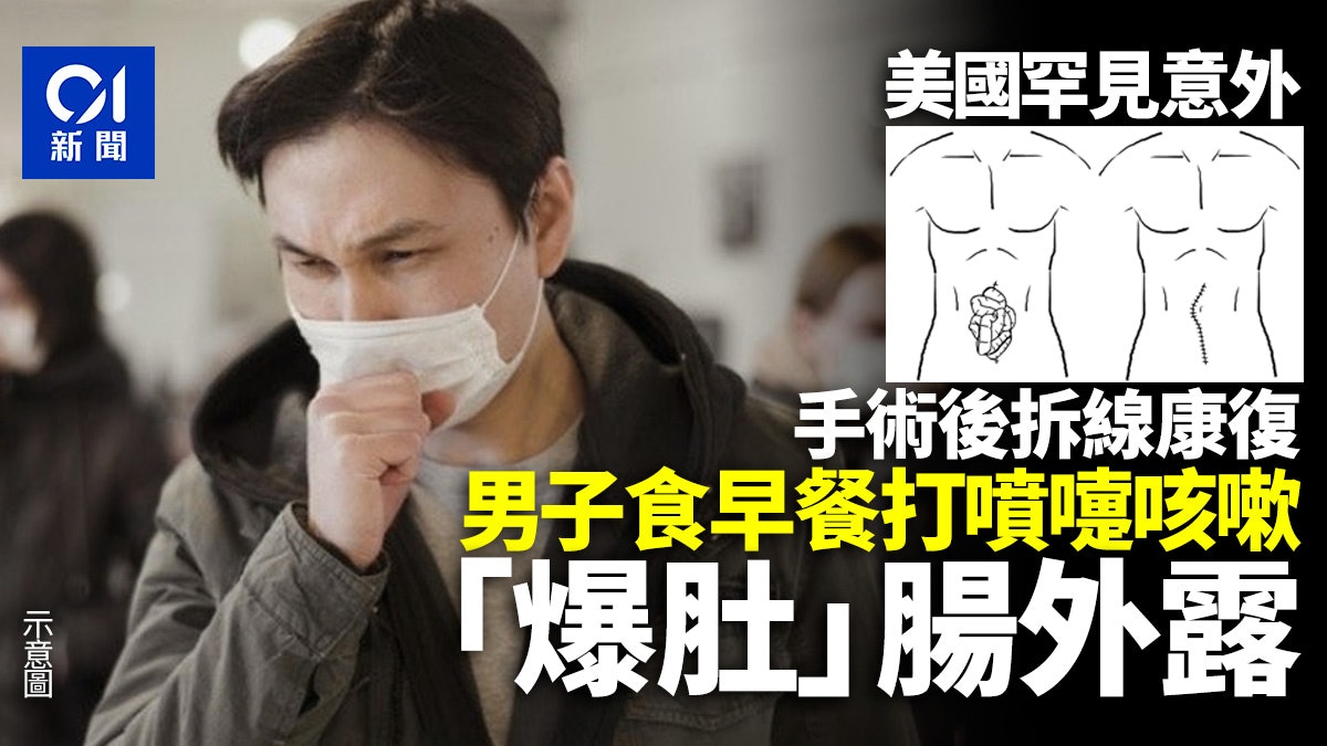 美國男子遇上罕見意外 打噴嚏+咳嗽引致「爆肚」腸外露 美國男子遇上罕見意外 打噴嚏+咳嗽引致「爆肚」腸外露