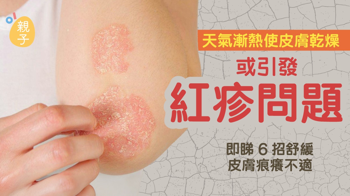 濕疹|麻煩在不只「痕癢」!幼年處理不善 心血管疾病風險也增加 濕疹|麻煩在不只「痕癢」!幼年處理不善 心血管疾病風險也增加