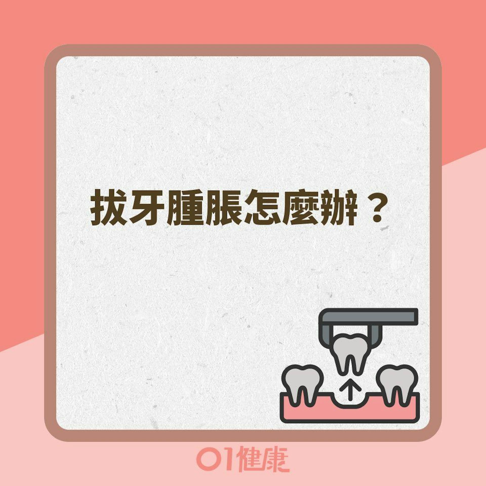 拔牙腫脹怎麼辦?(01製圖 ) 拔牙腫脹怎麼辦?(01製圖 )