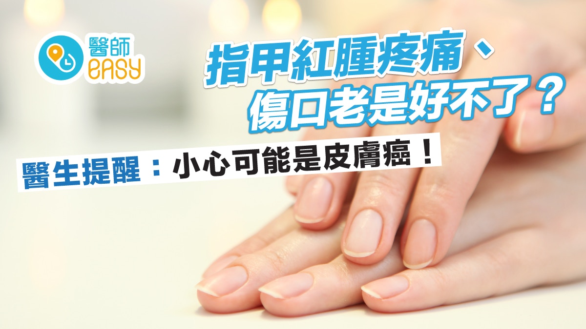癌症｜指甲紅腫疼痛、傷口老是好不了？醫提醒：小心可能是皮膚癌