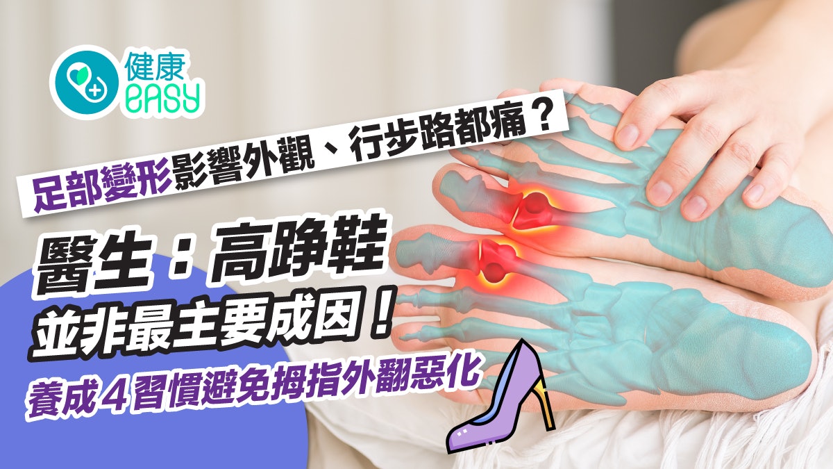 拇趾外翻|腳趾變形使外觀困擾走路疼痛?4習慣避免拇趾外翻惡化