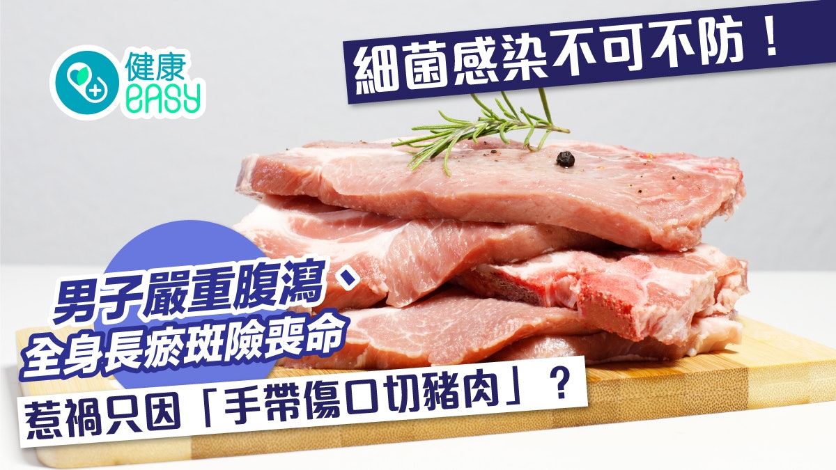 豬鏈球菌|男子嚴重腹瀉、全身長滿瘀斑 只因「手帶傷口切豬肉」 豬鏈球菌|男子嚴重腹瀉、全身長滿瘀斑 只因「手帶傷口切豬肉」