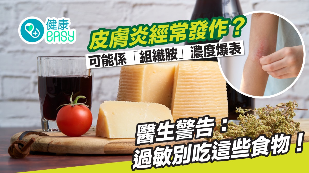 過敏|皮膚炎常發作?皮膚科醫生揭原因警告:過敏別吃這些食物 過敏|皮膚炎常發作?皮膚科醫生揭原因警告:過敏別吃這些食物