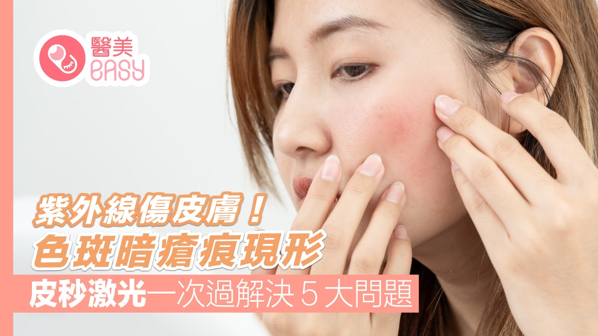 紫外線傷皮膚!色斑暗瘡痕現形 皮秒激光一次過解決5大問題 紫外線傷皮膚!色斑暗瘡痕現形 皮秒激光一次過解決5大問題
