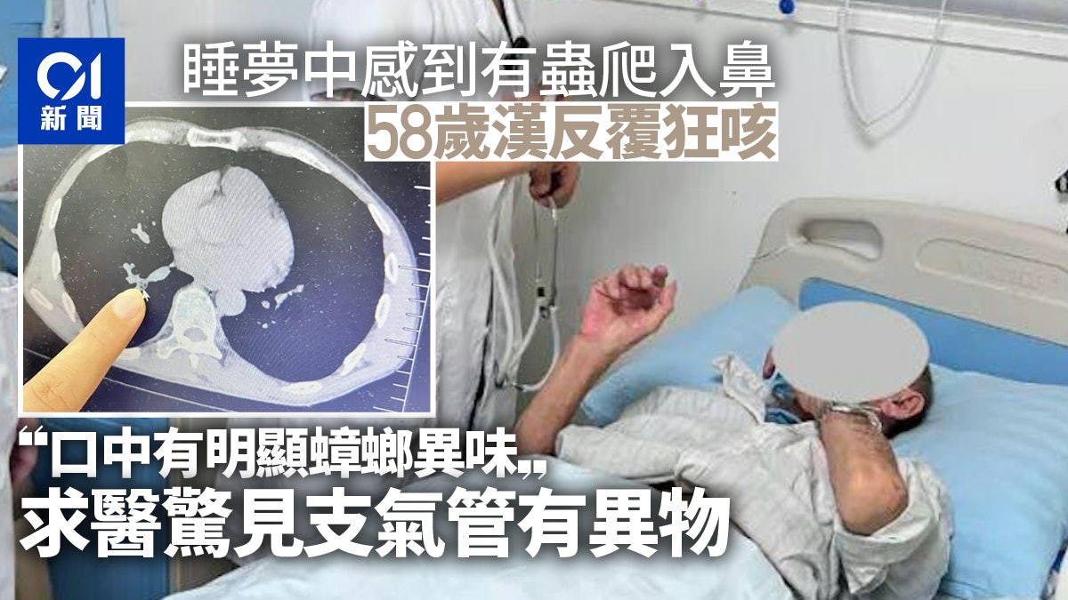 睡夢中遭曱甴捐鼻後狂咳 58歲漢嗆到氣管:口中有明顯蟑螂異味 睡夢中遭曱甴捐鼻後狂咳 58歲漢嗆到氣管:口中有明顯蟑螂異味