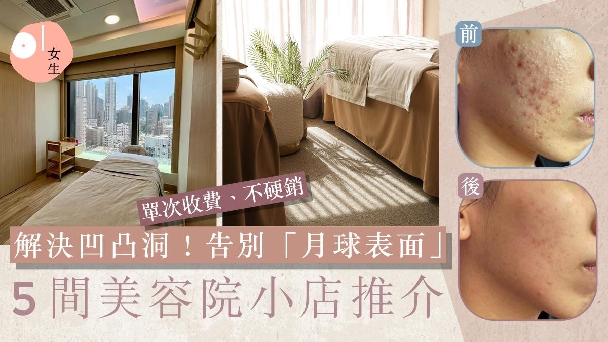 凹凸洞治療｜拆解凹凸洞成因及類型5大美容院比較去痘印零瑕疵