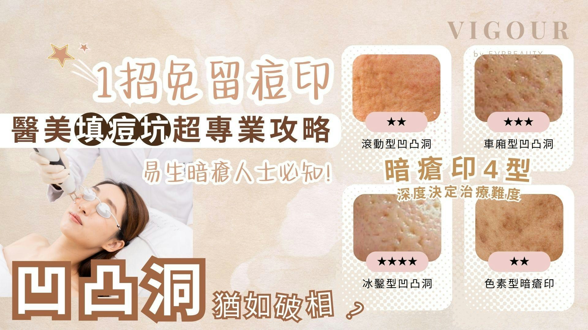 凹凸洞｜醫美填痘坑超專業攻略教你1招日後免留暗瘡印