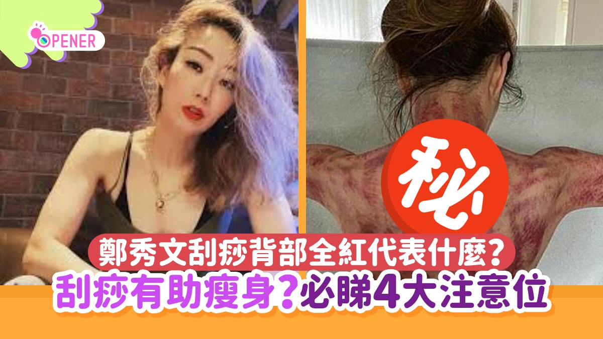 刮痧｜鄭秀文背部全紅代表什麼？有助瘦身？即睇4大刮沙冷知識