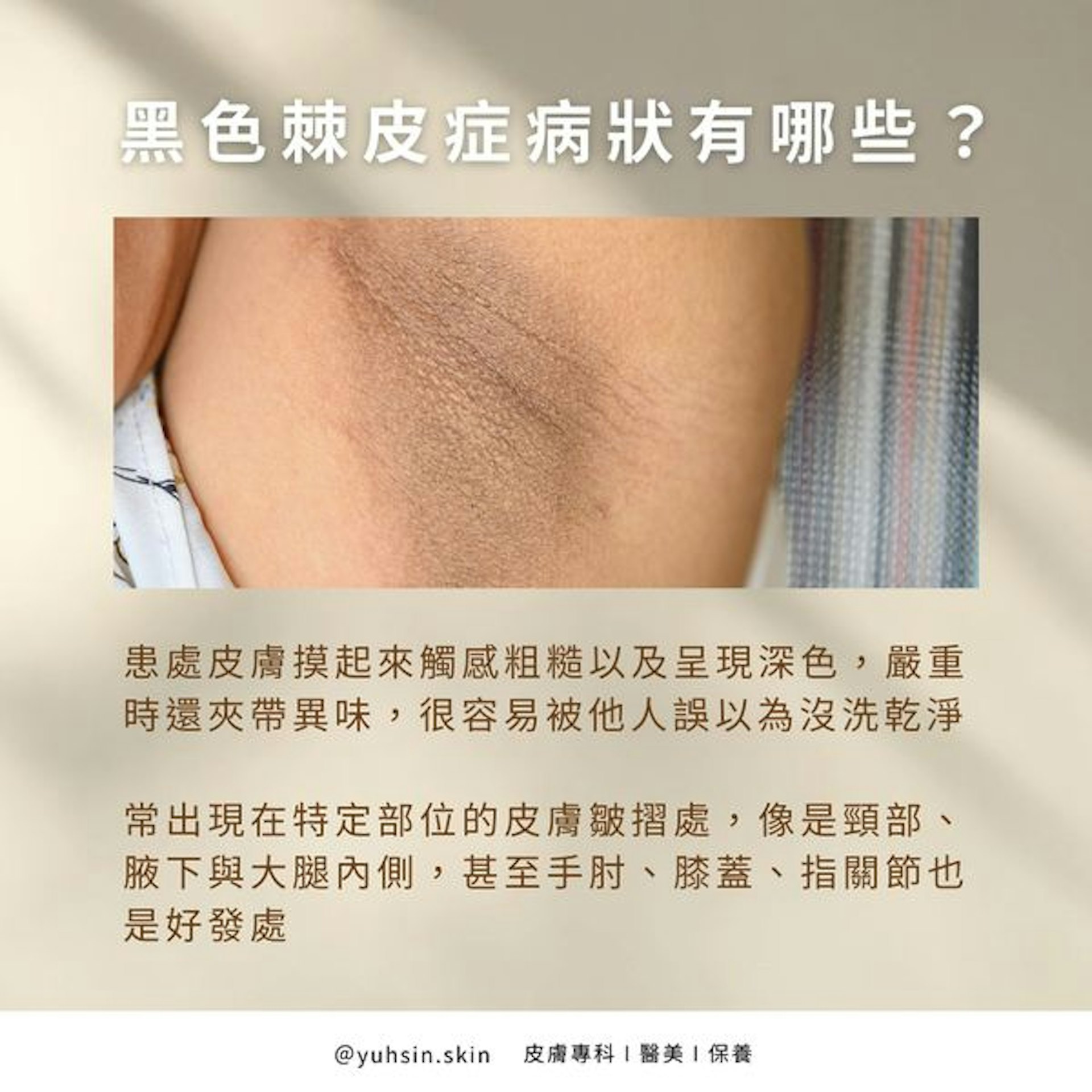黑色棘皮症的患處皮膚,摸起來觸感粗糙,且呈現深色,嚴重時還會夾帶異味(Facebook Page@皮膚專科 王佑鑫醫師) 黑色棘皮症的患處皮膚,摸起來觸感粗糙,且呈現深色,嚴重時還會夾帶異味(Facebook Page@皮膚專科 王佑鑫醫師)