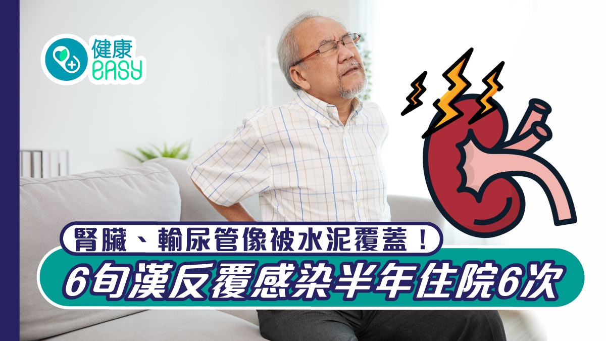 泌尿感染|腎臟、輸尿管像被水泥覆蓋!6旬漢反覆感染半年住院6次 泌尿感染|腎臟、輸尿管像被水泥覆蓋!6旬漢反覆感染半年住院6次