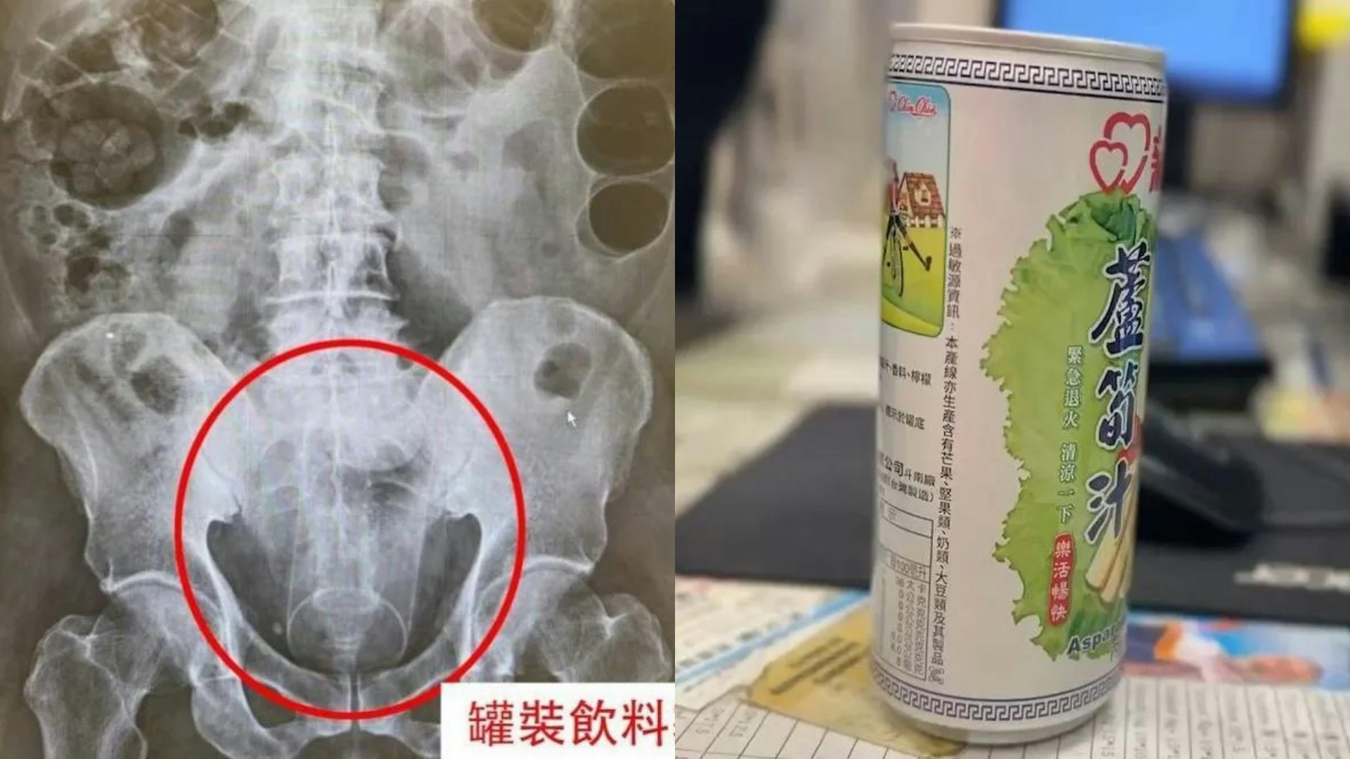 50歲男肛塞13cm罐裝飲料未係最誇 醫生揭更奇怪物品 電池都有份 50歲男肛塞13cm罐裝飲料未係最誇 醫生揭更奇怪物品 電池都有份
