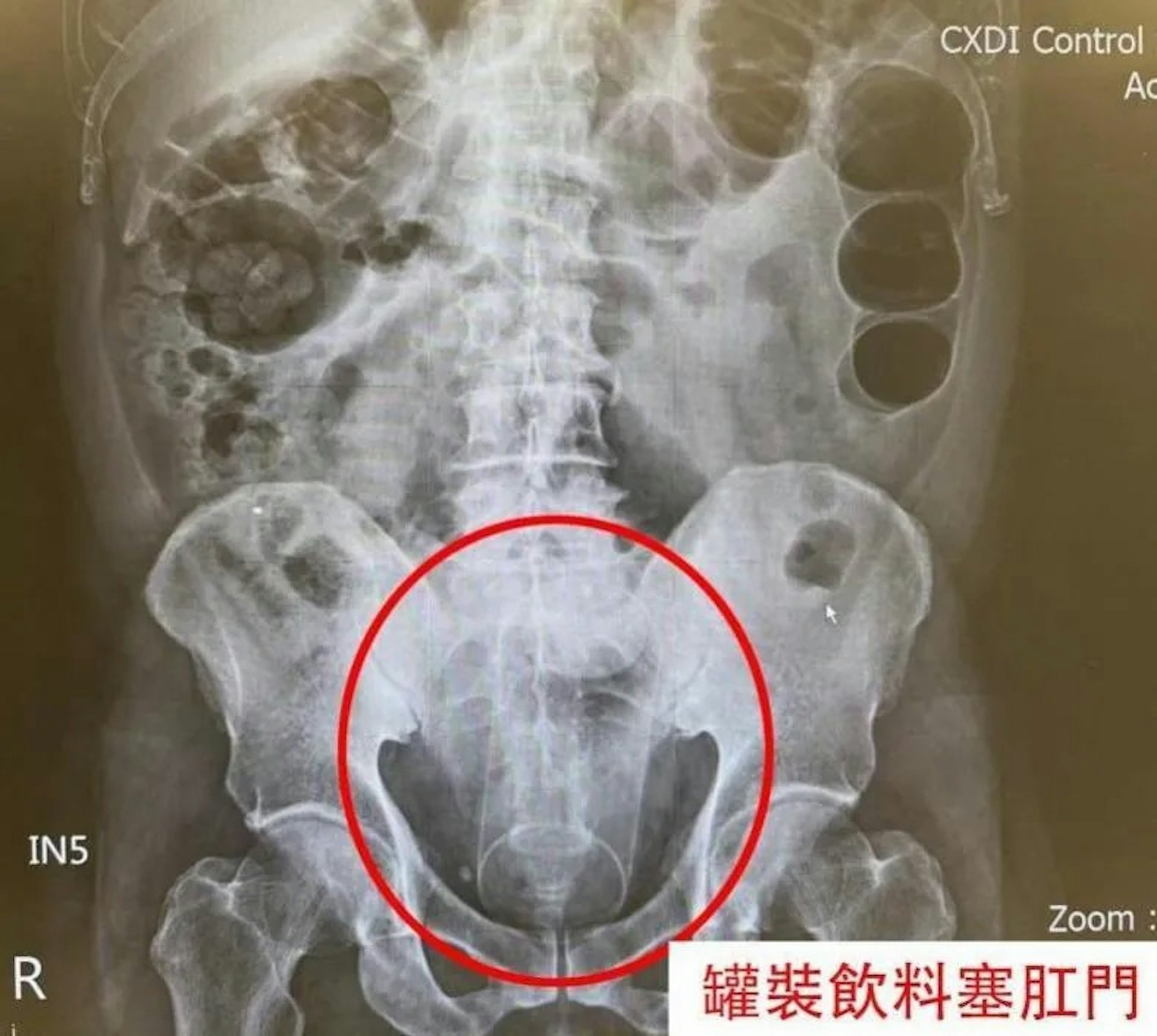肛門塞13厘米罐裝飲料。(中國醫藥大學新竹附設醫院提供) 肛門塞13厘米罐裝飲料。(中國醫藥大學新竹附設醫院提供)