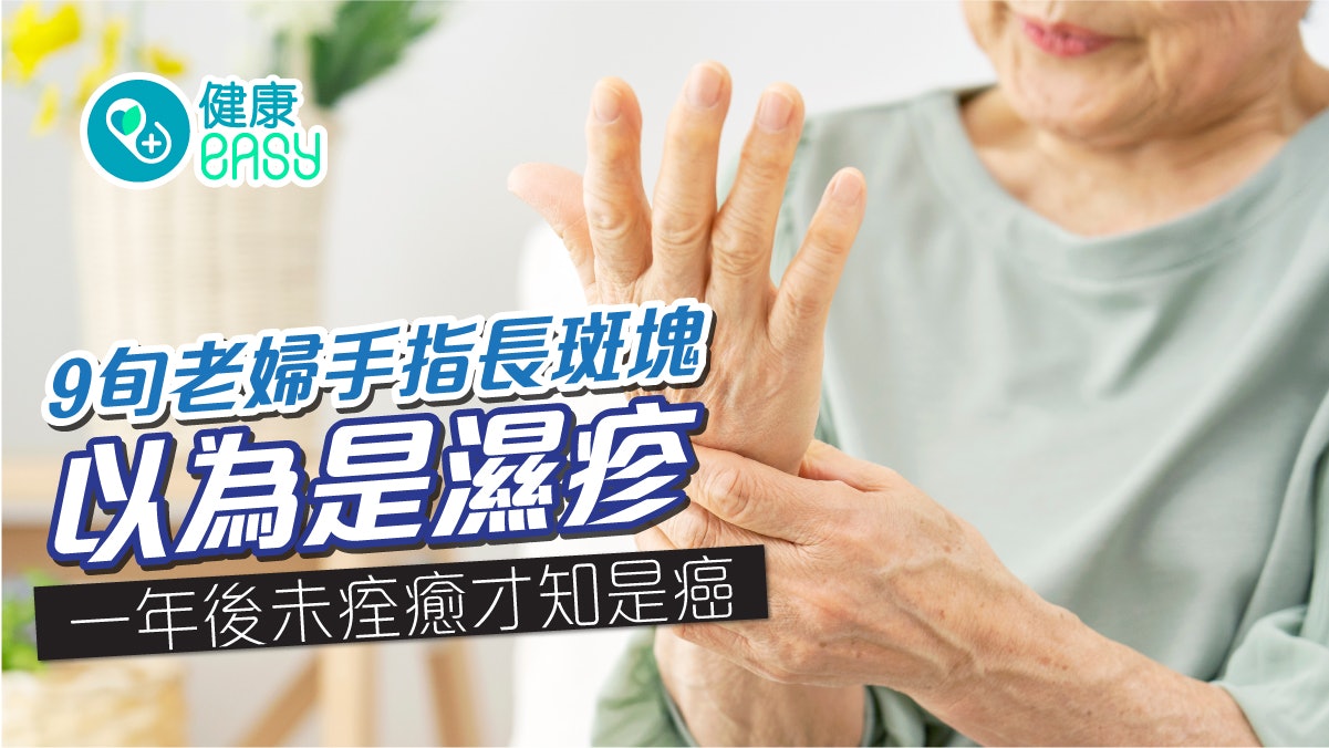 原位癌|9旬老婦手指長斑塊!以為是濕疹 一年後未痊癒才知是癌 原位癌|9旬老婦手指長斑塊!以為是濕疹 一年後未痊癒才知是癌