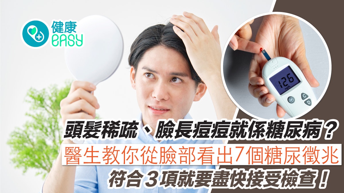 糖尿病|頭髮稀疏、滿臉暗瘡恐中招?7大臉部徵兆超過3項就醫檢查 糖尿病|頭髮稀疏、滿臉暗瘡恐中招?7大臉部徵兆超過3項就醫檢查