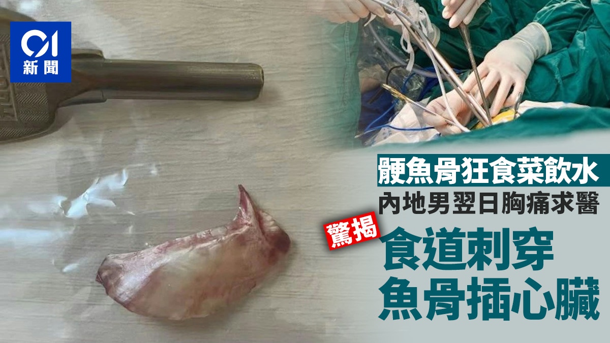 江西漢聚餐骾骨狂食菜飲水　胸痛求醫驚揭魚骨直插心臟