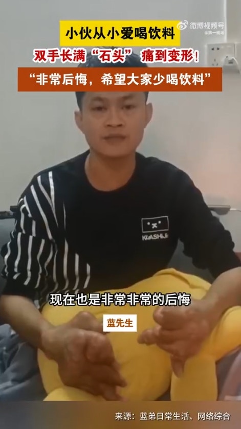 東莞一名男子長期把汽水奶茶當水喝，導致雙手長滿痛風結石，變形如「生薑」。（微博影片截圖）