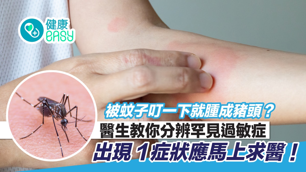 被蚊子咬一下就腫成豬頭?醫生教你辨別是過敏抑或斯基特症候群 被蚊子咬一下就腫成豬頭?醫生教你辨別是過敏抑或斯基特症候群