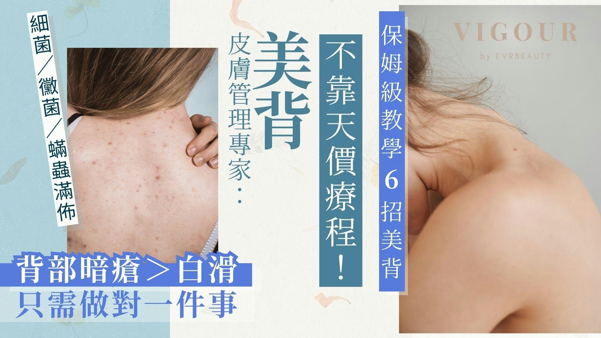 背部暗瘡|保姆級教學6招美背!醫美去暗瘡+嫩白一次做齊 背部暗瘡|保姆級教學6招美背!醫美去暗瘡+嫩白一次做齊
