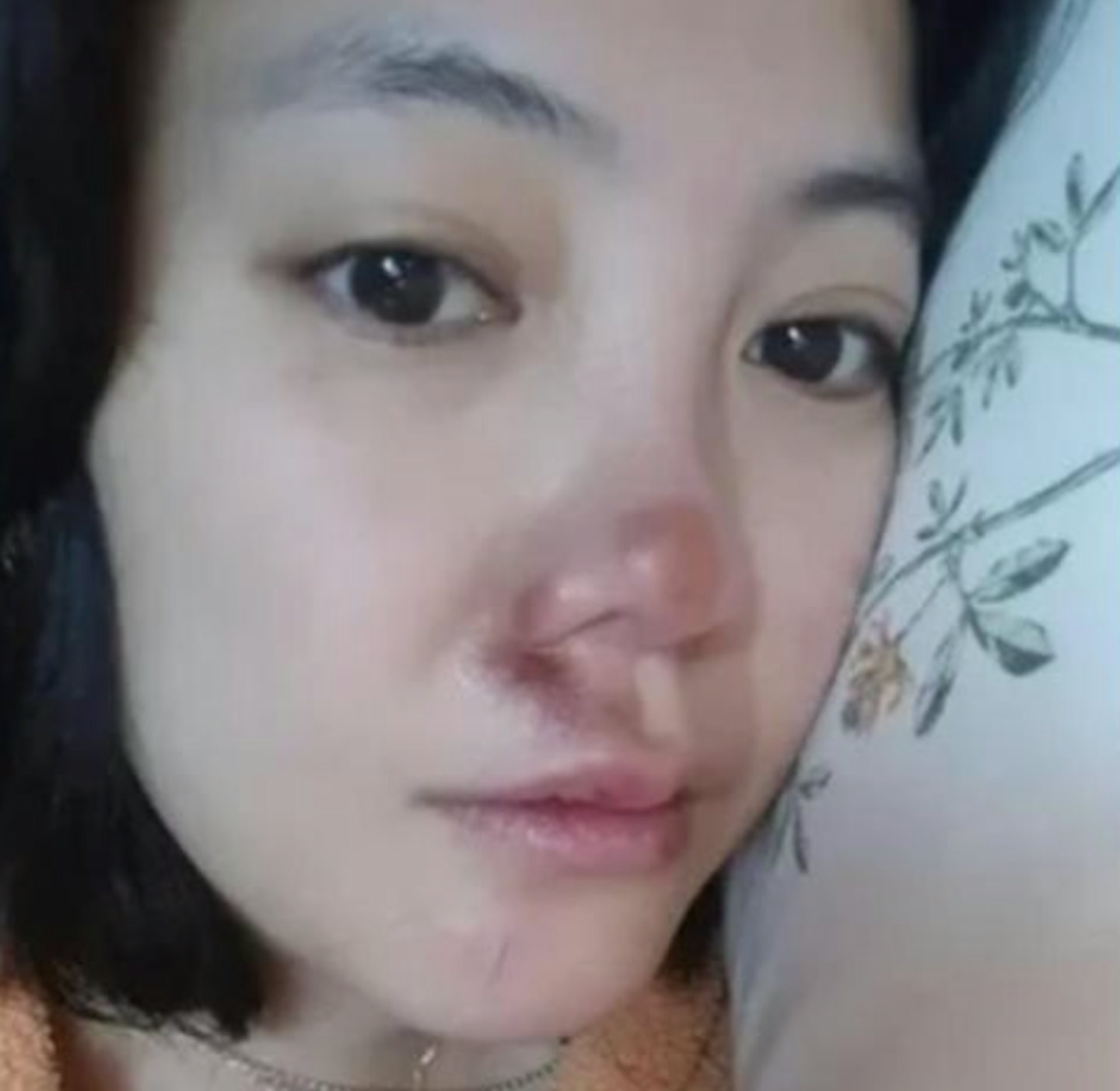 高恩雅最近跌倒,鼻子受傷。(ig@koeuna88) 高恩雅最近跌倒,鼻子受傷。(ig@koeuna88)