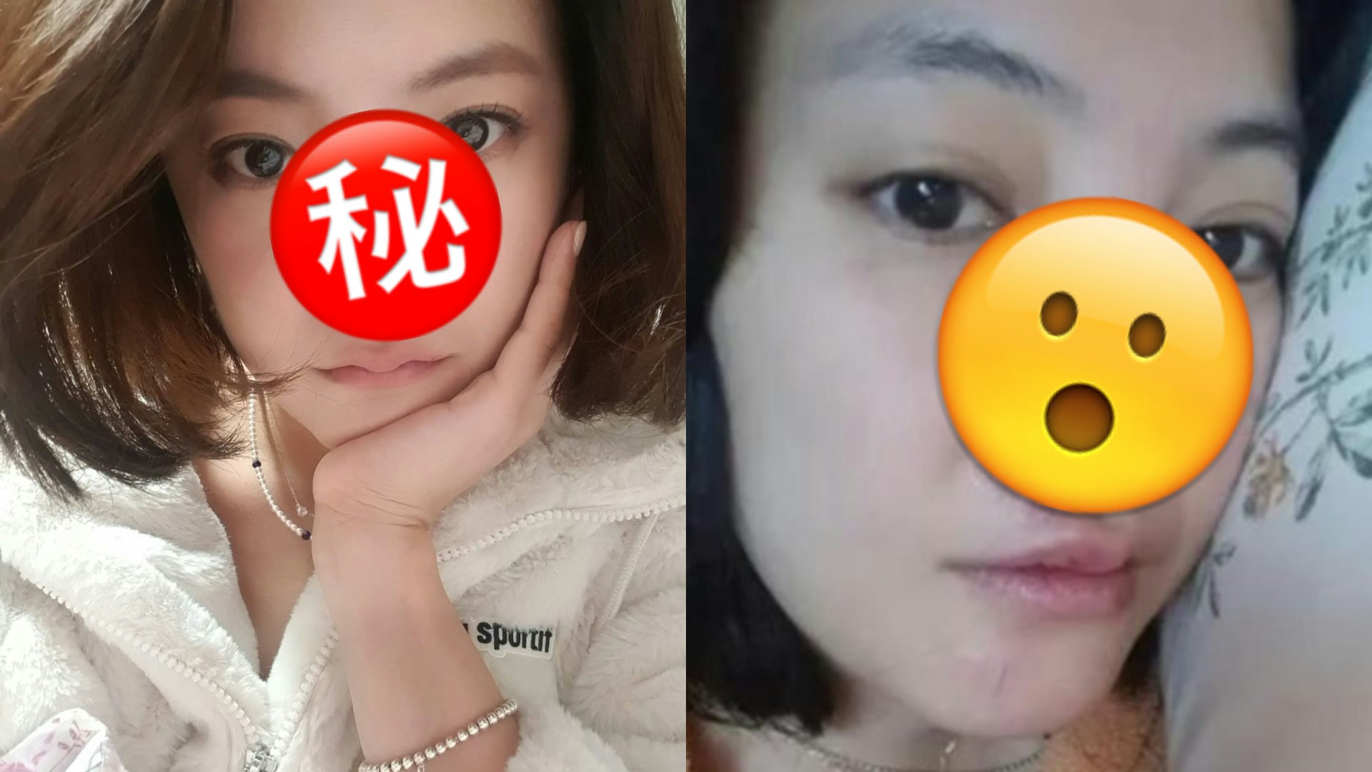 韓美女隆鼻失敗 動刀修復後跌倒又破相 IG曬傷勢:害怕留下疤痕 韓美女隆鼻失敗 動刀修復後跌倒又破相 IG曬傷勢:害怕留下疤痕