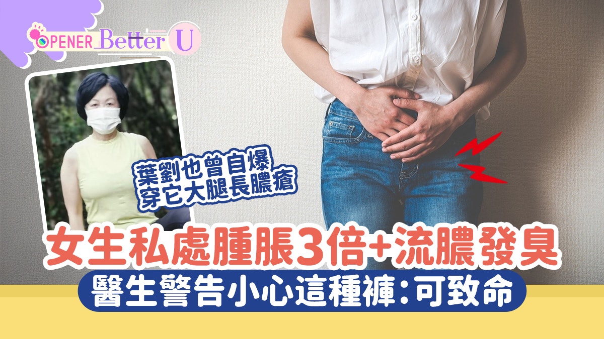 女生私處腫脹3倍+流膿發臭!醫生:1類褲惹禍 葉劉大髀都生過膿瘡 女生私處腫脹3倍+流膿發臭!醫生:1類褲惹禍 葉劉大髀都生過膿瘡