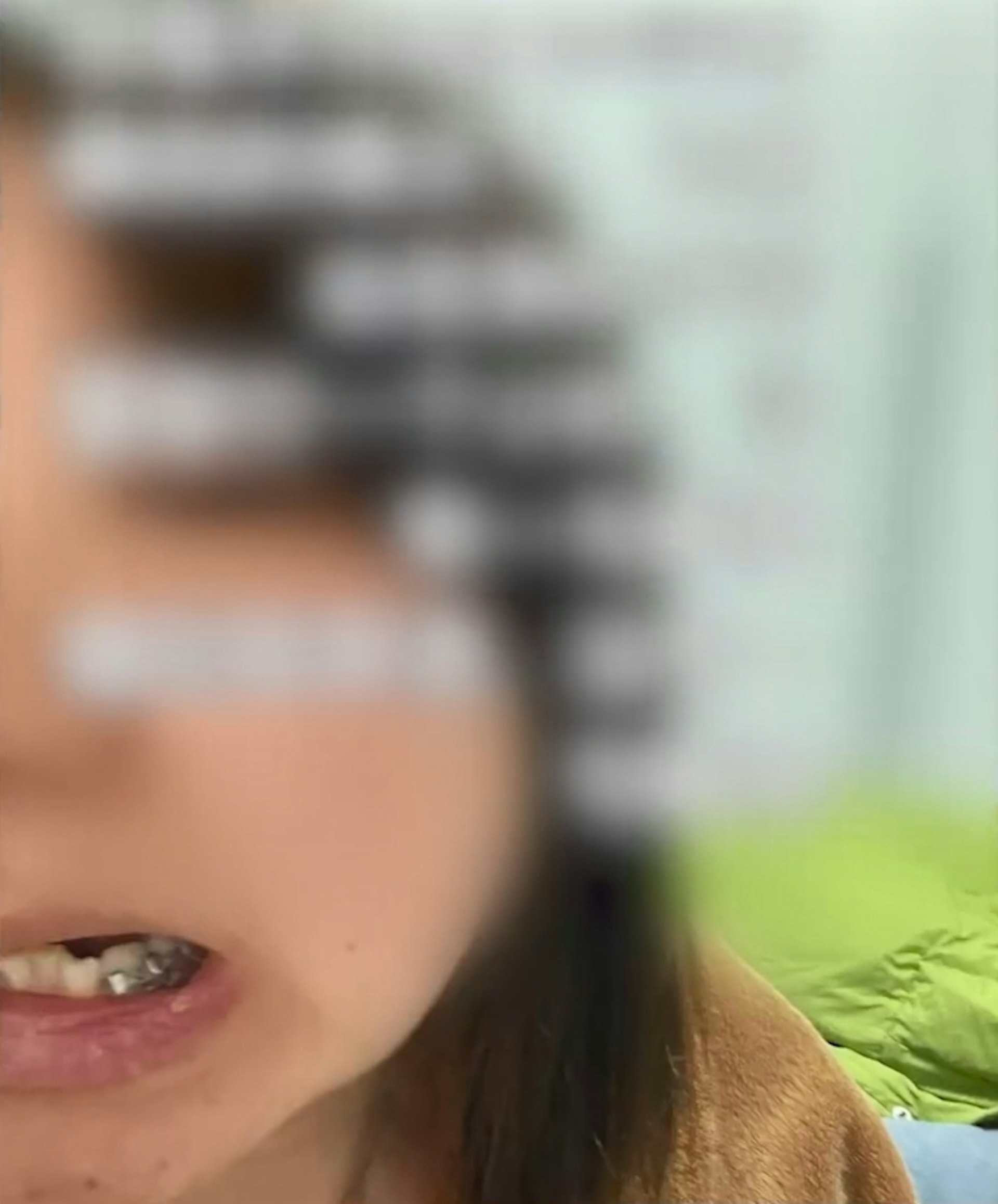 34歲女子遭牙醫拔錯一顆原生牙齒,牙醫將該原生牙齒塞回到智慧齒的位置。(影片截圖) 34歲女子遭牙醫拔錯一顆原生牙齒,牙醫將該原生牙齒塞回到智慧齒的位置。(影片截圖)