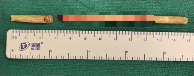 吃麥芽糖不慎摔倒！12cm竹籤從口插進6歲男童小腦刺穿頸靜脈球