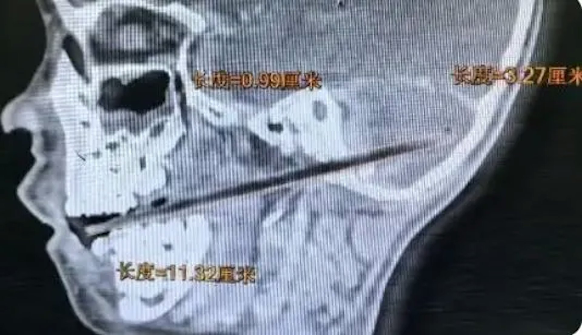 吃麥芽糖不慎摔倒!12cm竹籤從口插進6歲男童小腦刺穿頸靜脈球