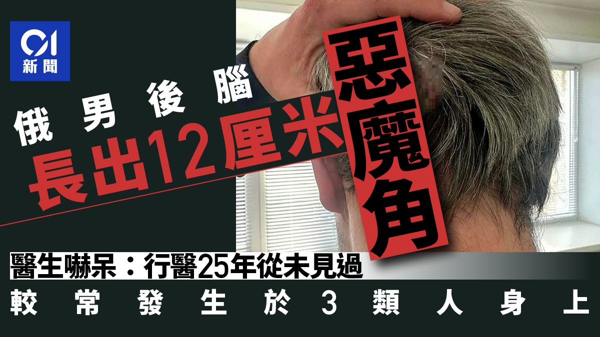 俄男後腦突長出「12厘米惡魔角」嚇呆外科醫生:行醫25年從未見過 俄男後腦突長出「12厘米惡魔角」嚇呆外科醫生:行醫25年從未見過