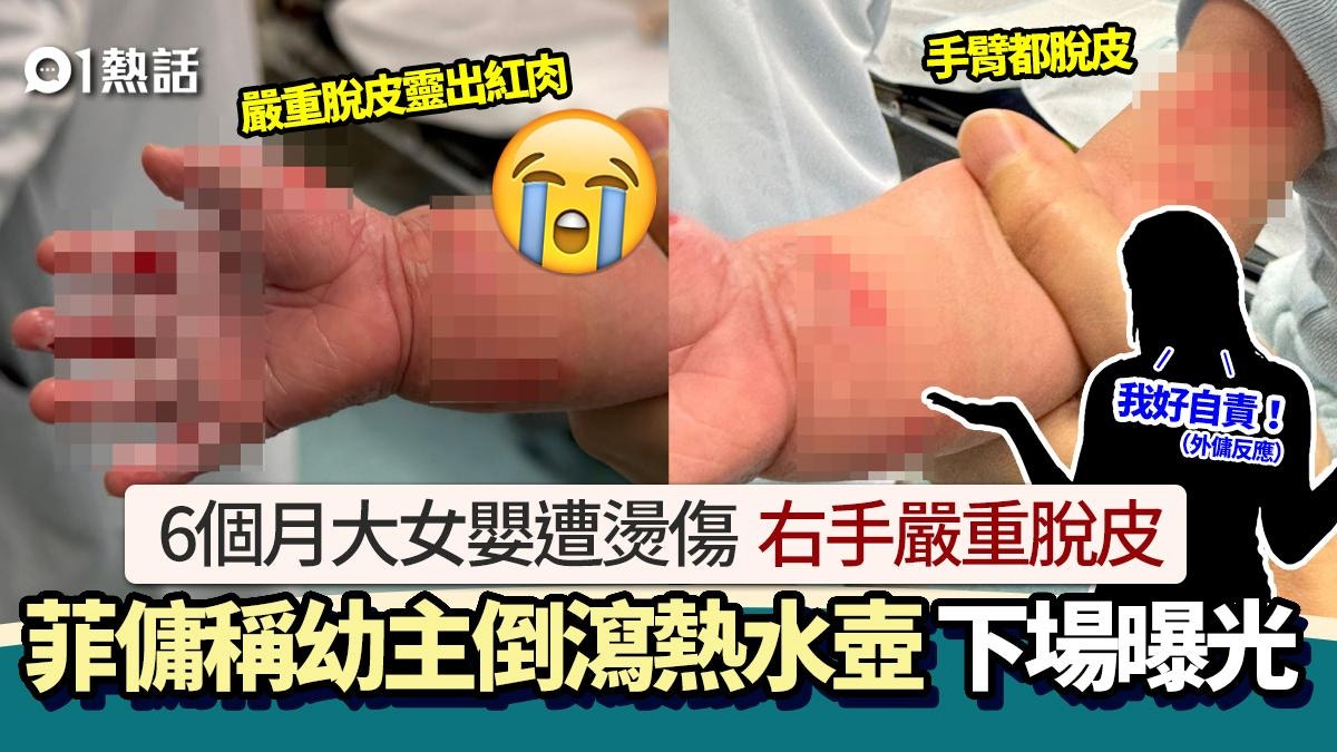 菲傭稱幼主倒瀉熱水壺！6個月BB嚴重燙傷脫皮　後續更離譜終被炒