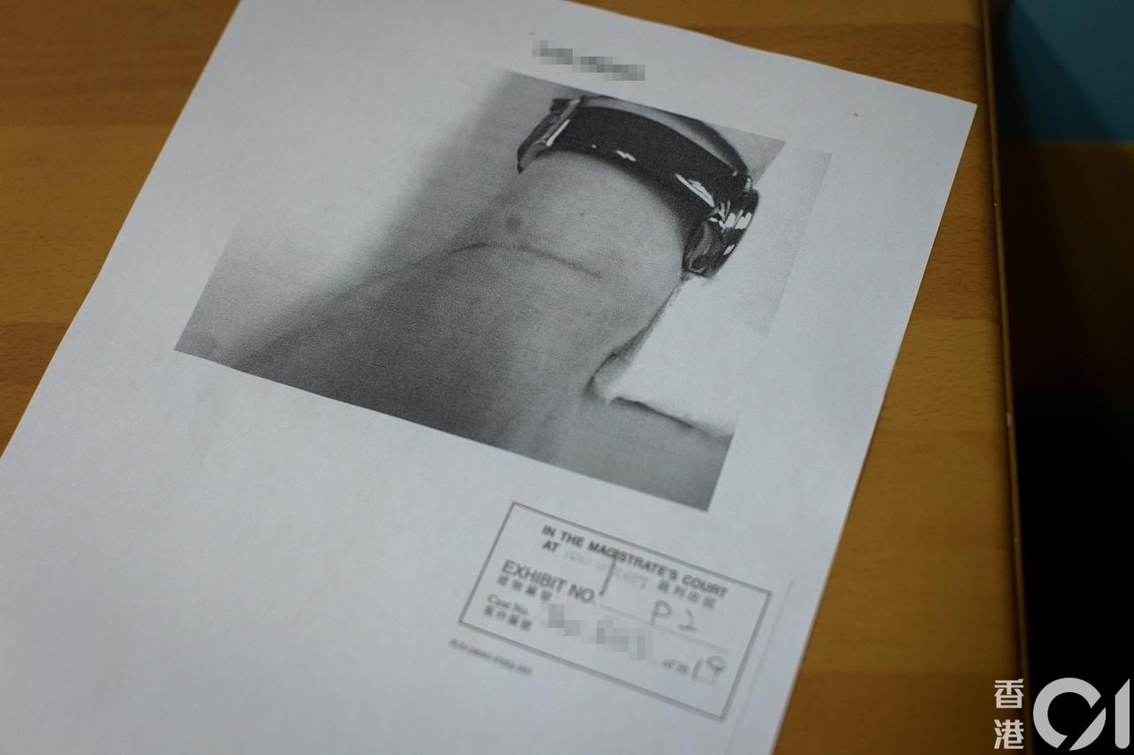醫療報告中，附有一名食環署女助理小販管理主任報稱被人以原子筆刮傷手相片，前臂上有一條紅色傷痕、沒有流血。（羅國輝攝）