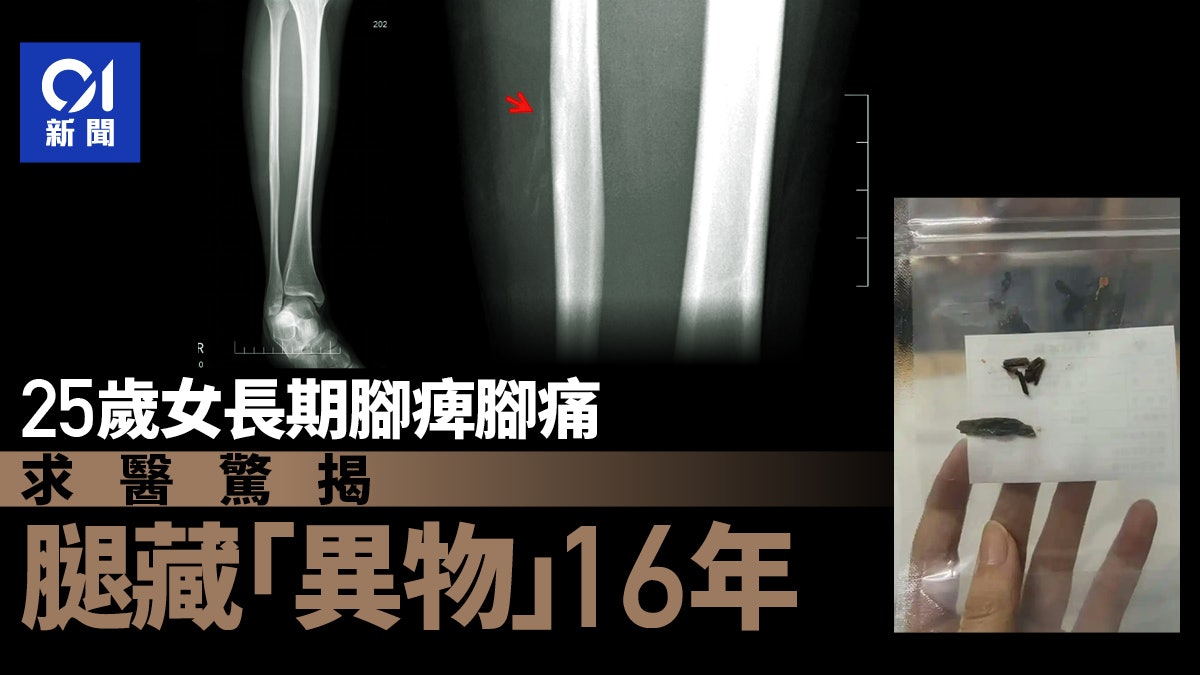 湖南25歲女腿痛兼長期腳痺 醫取出16年前埋腿內異物 湖南25歲女腿痛兼長期腳痺 醫取出16年前埋腿內異物