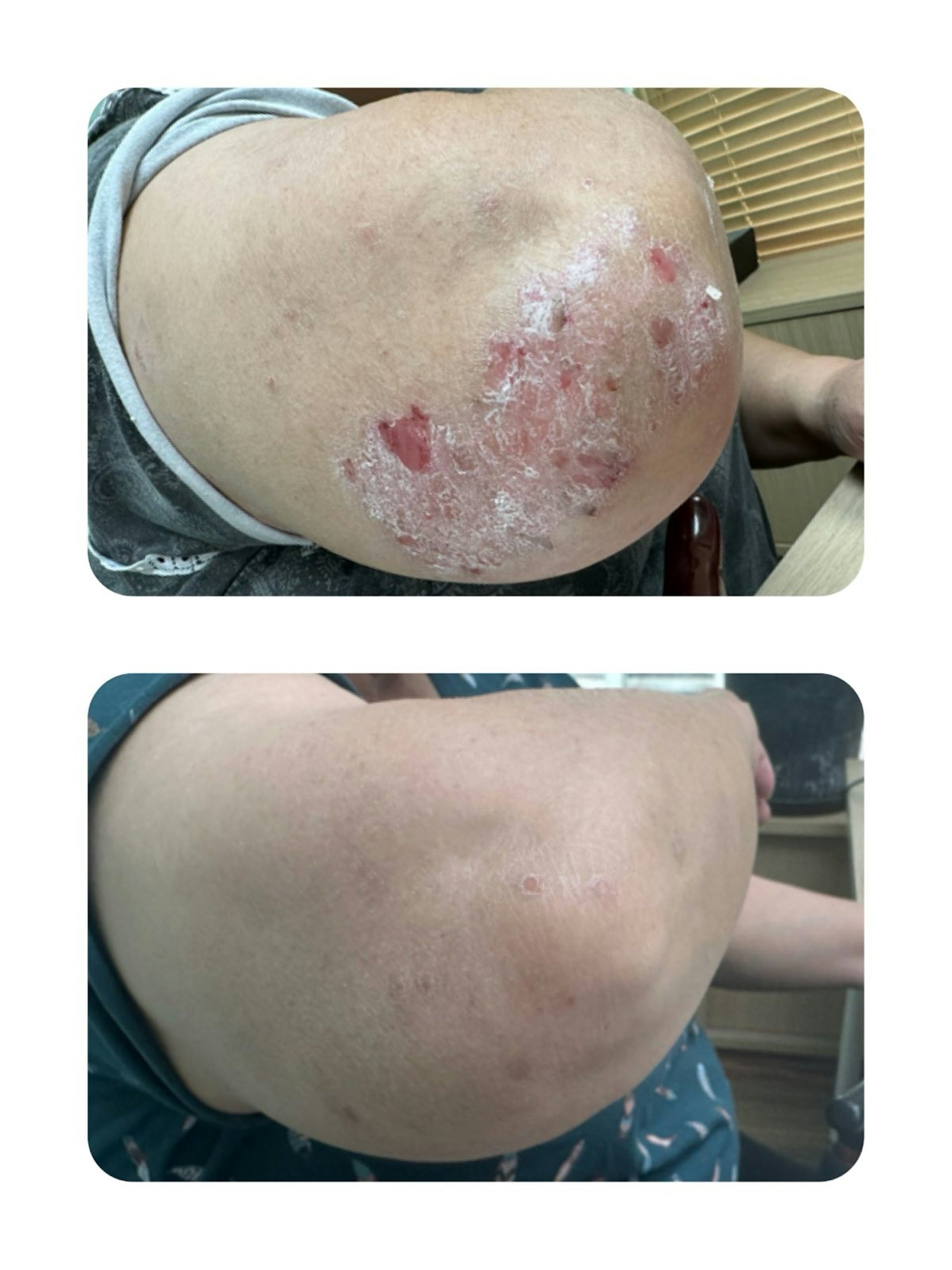 上圖為一名病人患上濕疹的情況,下圖為該名病人的濕疹經治療後獲得改善的情況。(作者提供) 上圖為一名病人患上濕疹的情況,下圖為該名病人的濕疹經治療後獲得改善的情況。(作者提供)