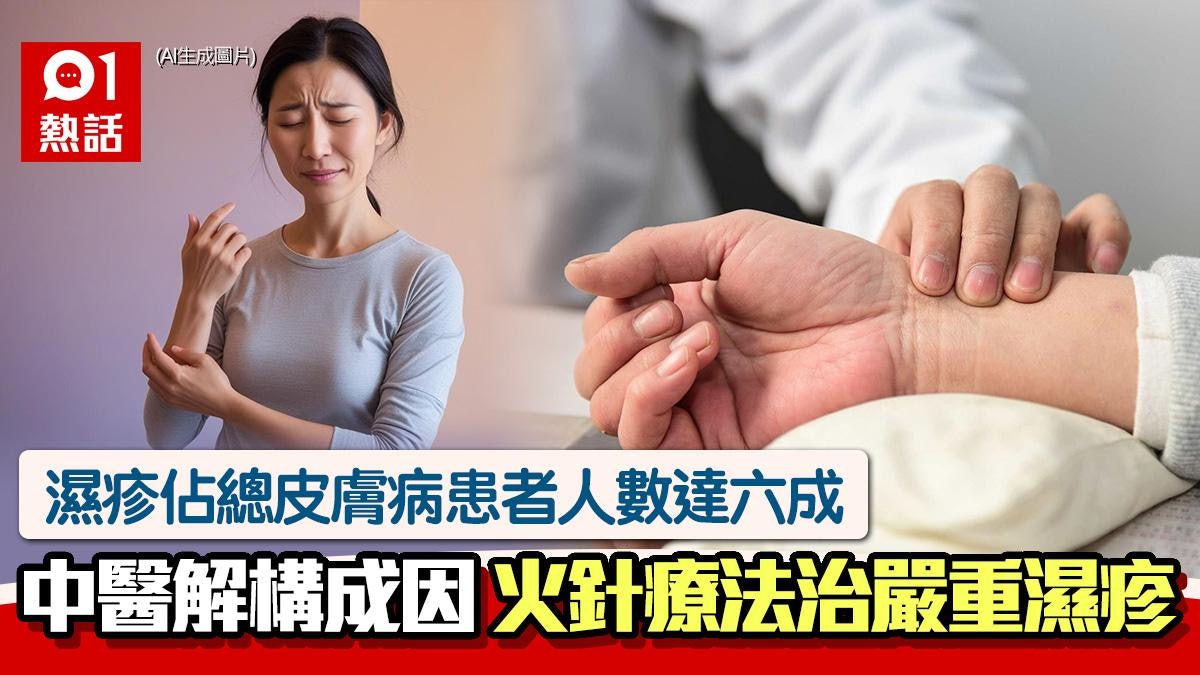 濕疹|中醫解構治療方法 嚴重濕疹皮膚流滋滲血 可試火針療法 濕疹|中醫解構治療方法 嚴重濕疹皮膚流滋滲血 可試火針療法