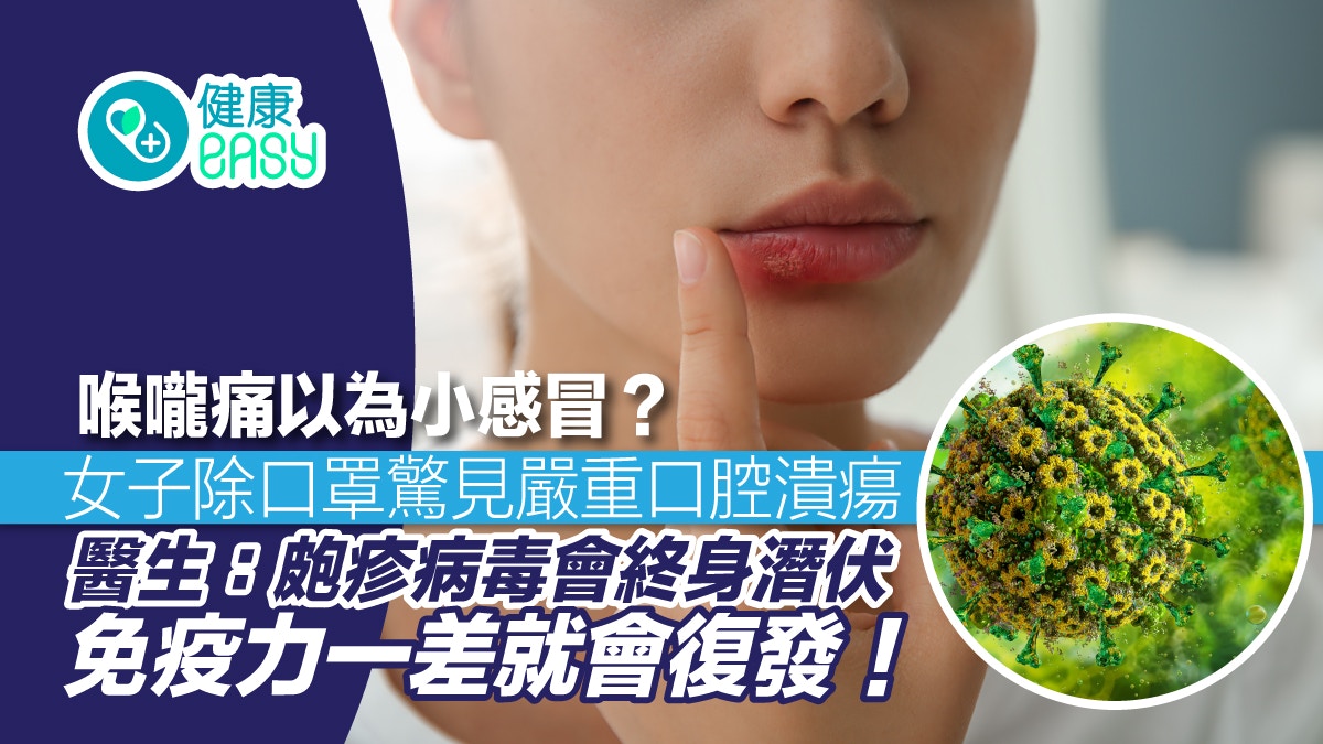 唇皰疹｜嘴唇潰爛嚇怕醫生？病毒會終身潛伏 免疫力一差就復發！