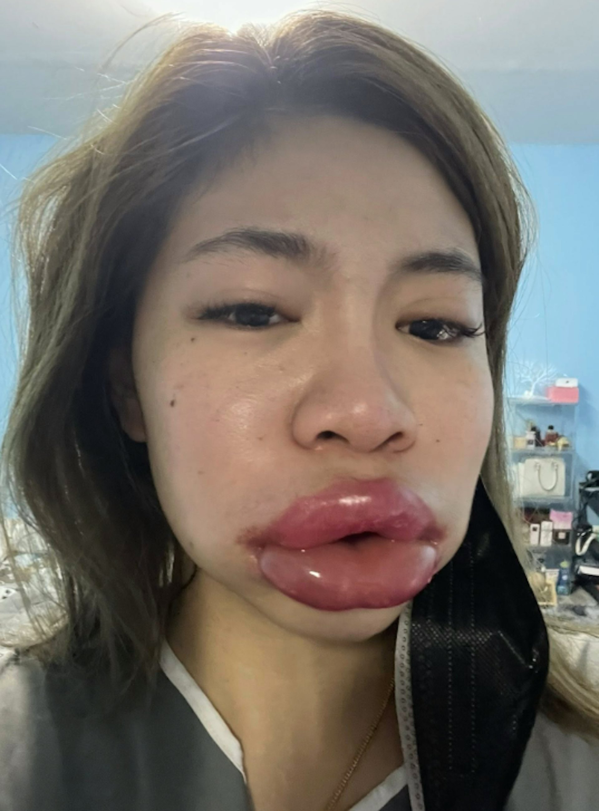 梅納魯吉分享2年前在嘴唇打透明質酸,嘴唇過敏腫成巨形「孖潤腸」的慘況。(fb圖片) 梅納魯吉分享2年前在嘴唇打透明質酸,嘴唇過敏腫成巨形「孖潤腸」的慘況。(fb圖片)