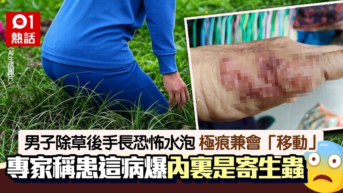 男子除草後手長恐怖水泡!極痕且會移動 專家:感染寄生蟲患這病