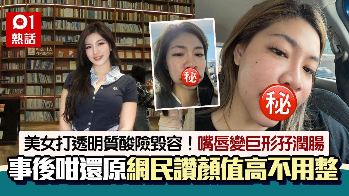 美女嘴唇打透明質酸 過敏腫如孖潤腸險毀容 網民讚顏值高不必整 美女嘴唇打透明質酸 過敏腫如孖潤腸險毀容 網民讚顏值高不必整