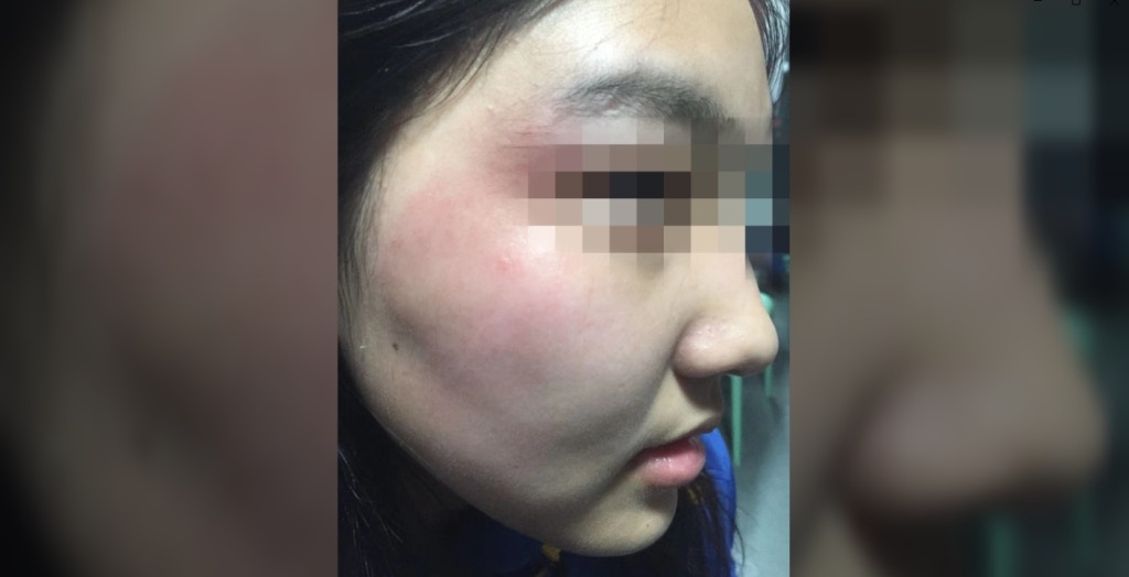 武漢17歲女遭男同學打致顱腦損傷 家屬質疑案件進展緩慢