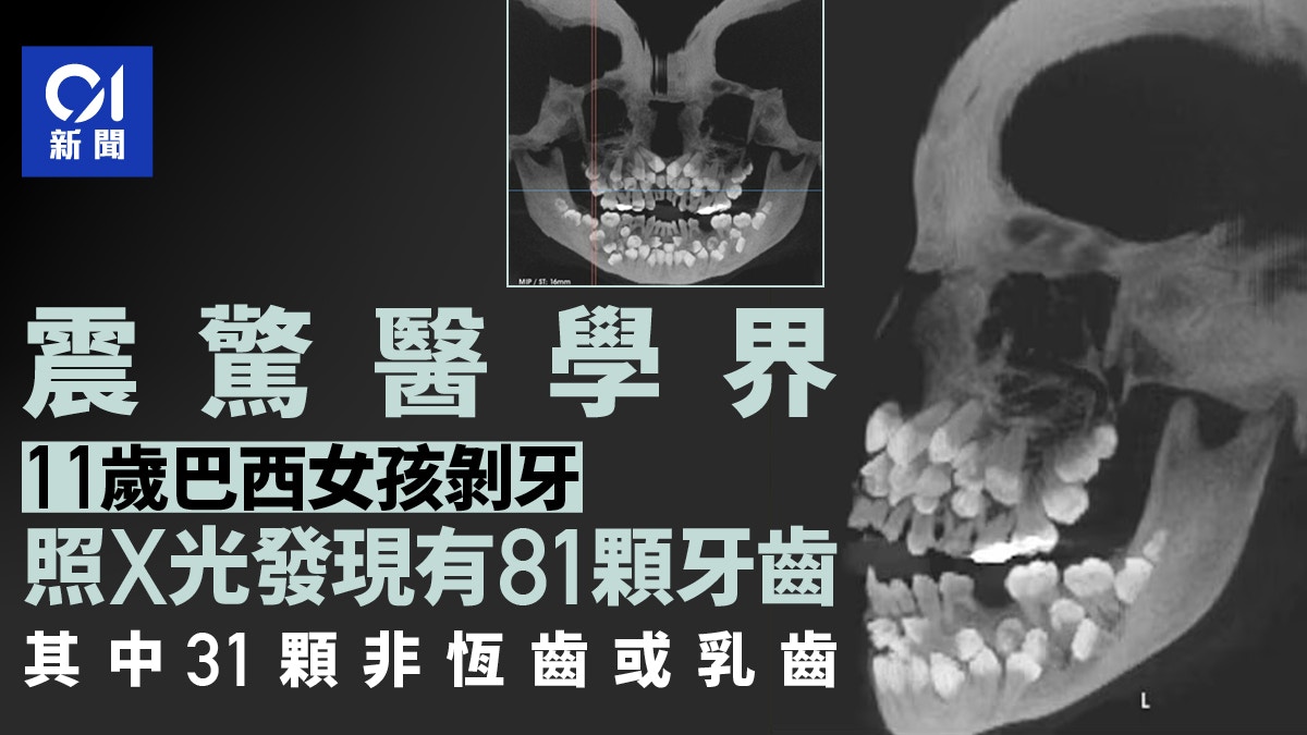 女童想拔牙照X光驚見81顆牙 31顆非恆齒或乳齒