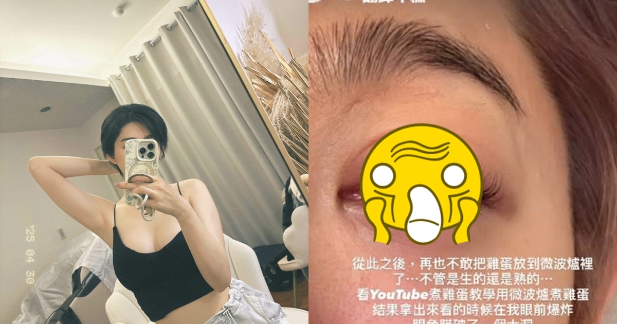王晴微波爐煮雞蛋爆炸 眼角膜破裂緊急送院:從此再也不敢