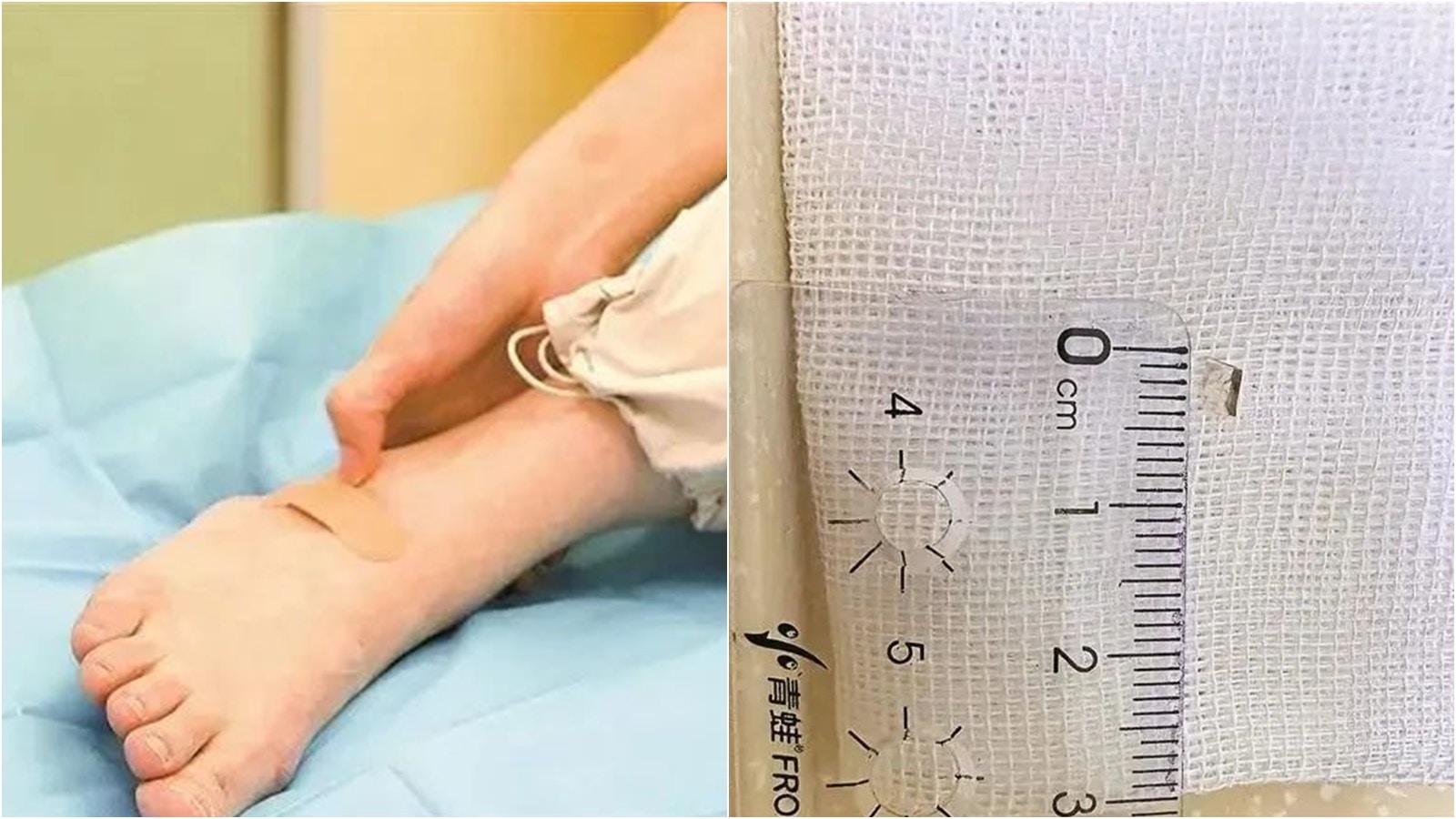 深圳婦右腳背劇痛難耐 求醫揭4mm玻璃碎潛伏8年之久