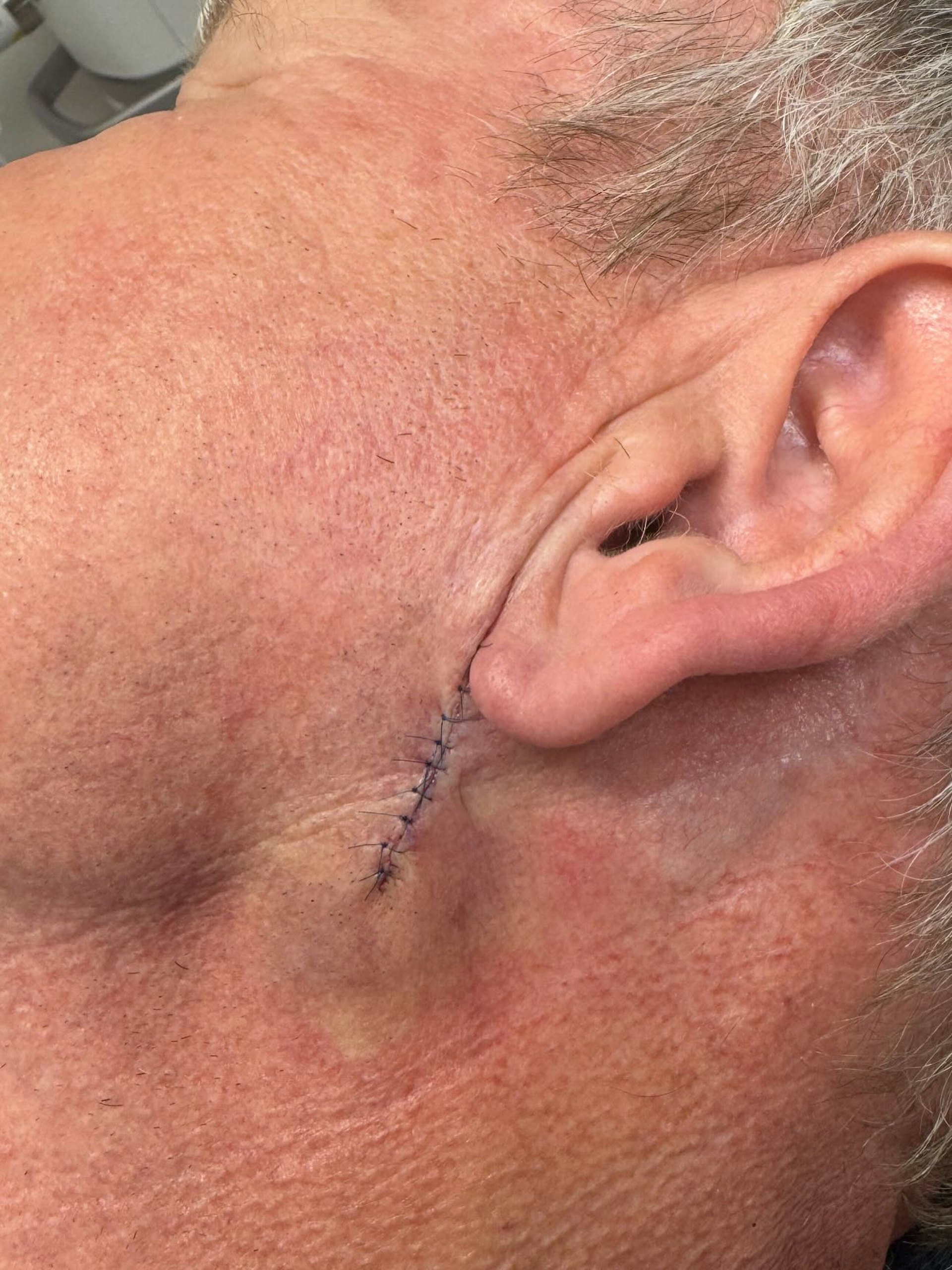 Gordon Ramsay 30日在社群突然發文,公開自己罹患皮膚癌,並已接受手術切除癌細胞。(IG@gordongram)